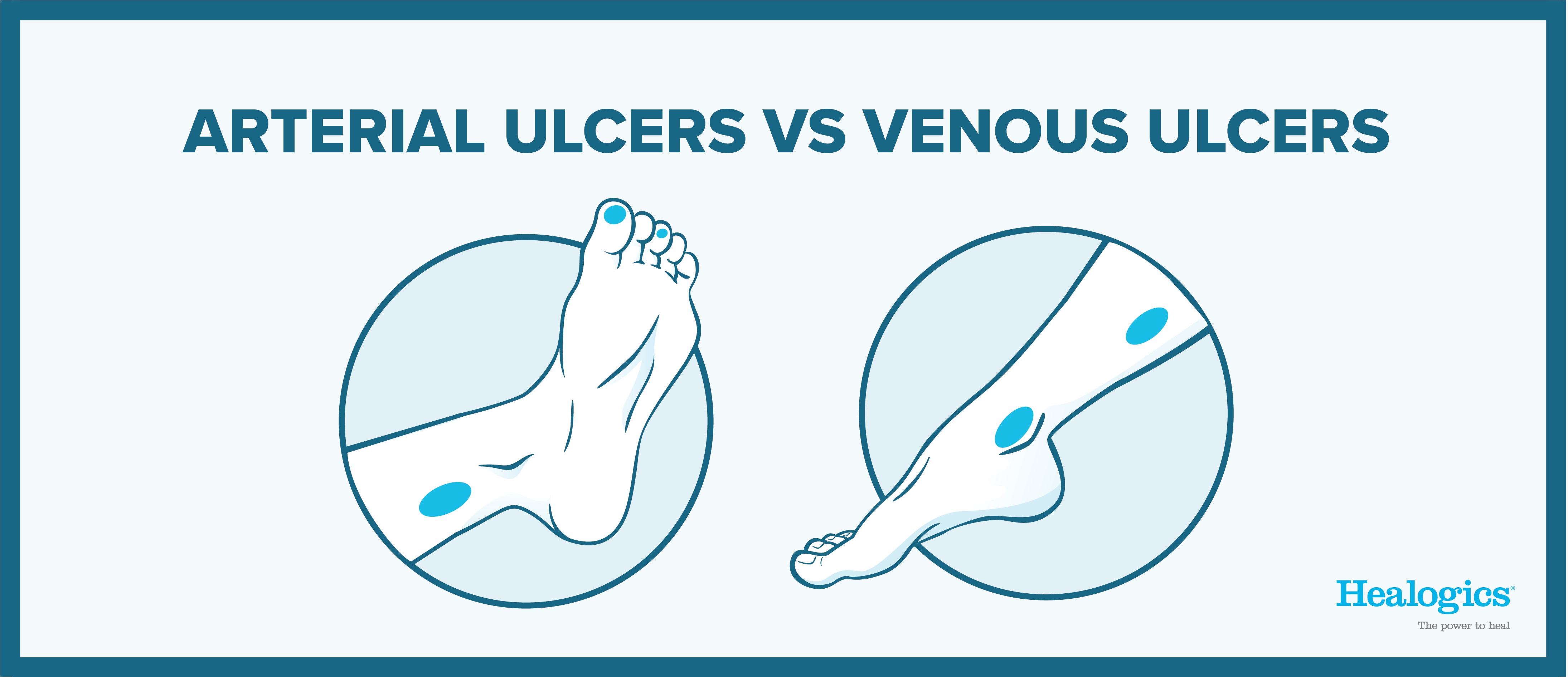 arterial vs venous ulcers